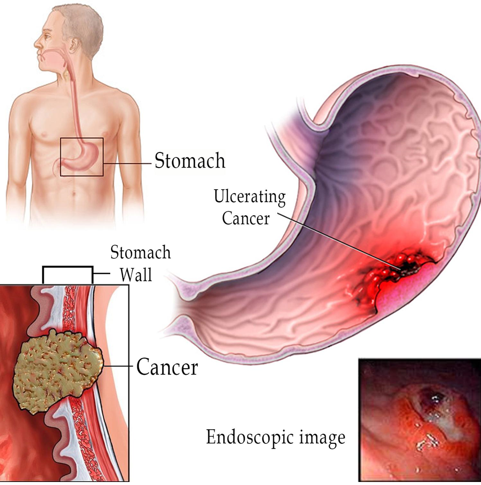 Walking You Through Stomach or Gastric Cancer